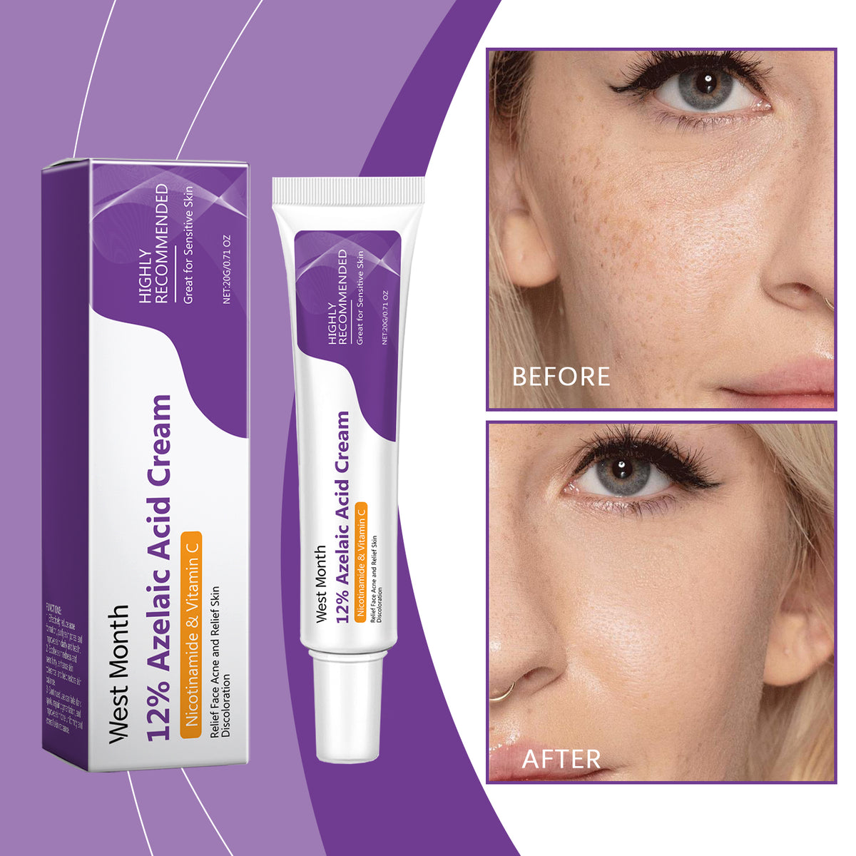 Azelaic Acid Cream