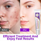 12% Azelaic Acid & 15% Azelaic Acid