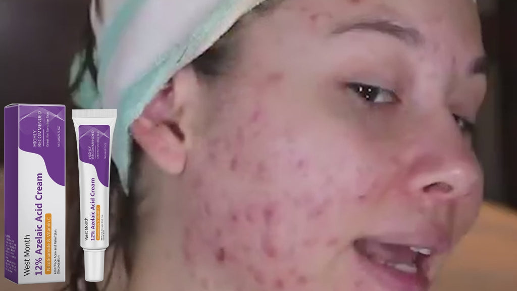 Azelaic Acid Cream