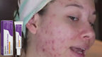 Azelaic Acid Cream